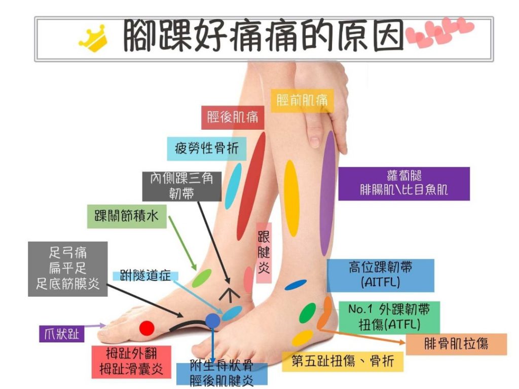 leg pain
